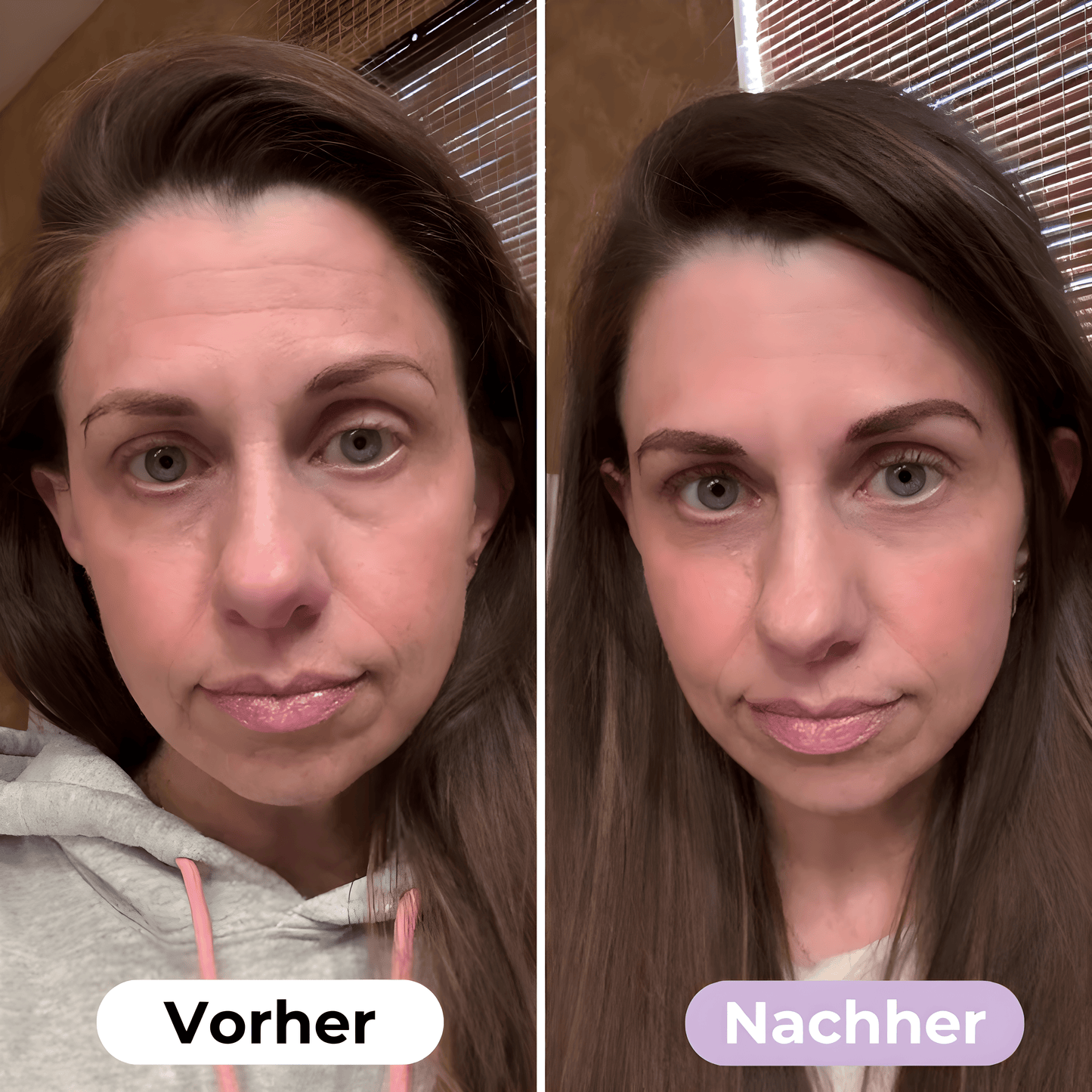 ScarRelief ™ | Silikon-Narbenpflaster